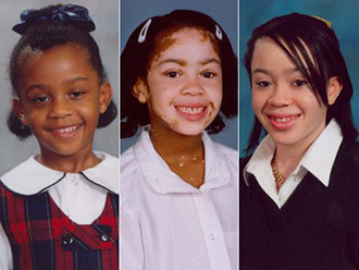 Latest Vitiligo Treatment