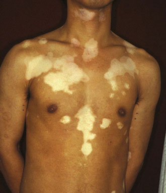 Types of Vitiligo Treatment